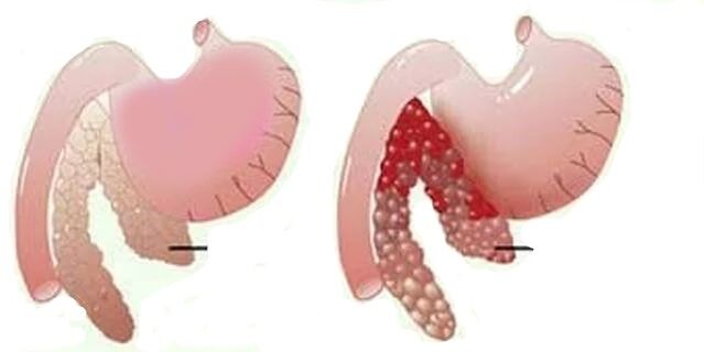 pankreatitis